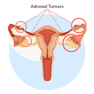 Gynaecological Problems Image